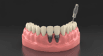 Implantes Dentales Sin Tornillos: Aclarando la Verdad sobre esta Tecnología 3 implantes dentales sin tornillos