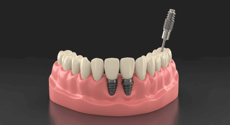 implantes dentales sin tornillos​