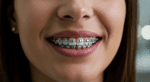 brackets transparentes