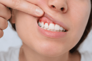Revisión de encías con sangrado en Clínica Dental Tapias, Alcorcón