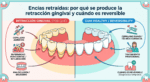 Encías retraídas
